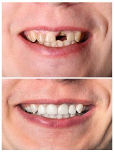 Emergency dental crown missing tooth